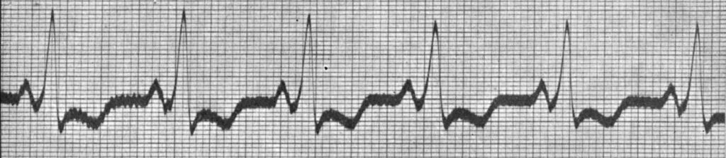 1929 Bach WPW paroxysmal tachycardia of forty-eight years' duration and right branch bundle block