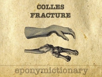 Colles-fracture-distal-radius-LITFL 340 2