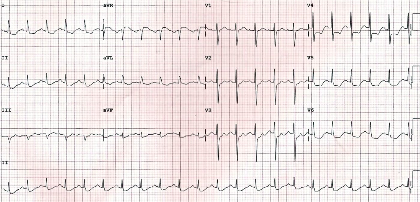 ECG LMCA
