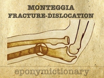 Monteggia fracture-dislocation 340
