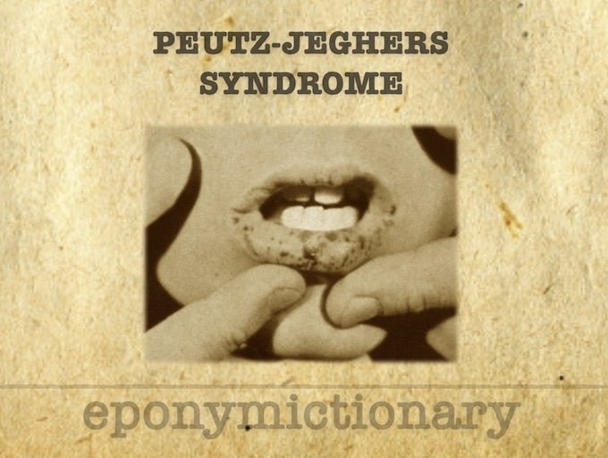 Peutz-Jeghers syndrome 340