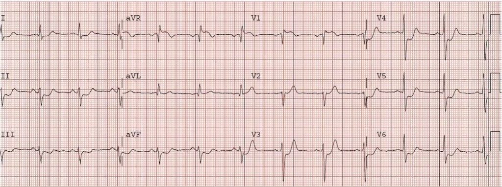 STE-aVR-ostial-LAD-thrombus
