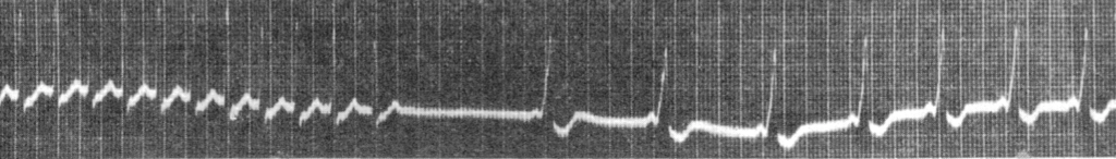 Wedd 1921 short PR and delta wave tachycardia